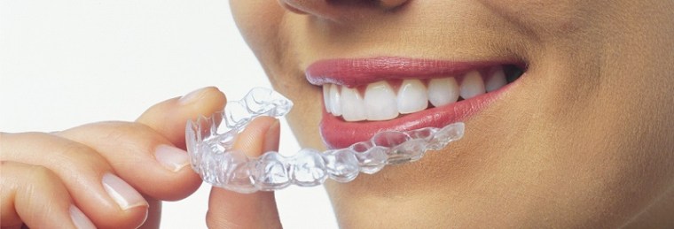 invisalign-ortodonzia-trasparentre